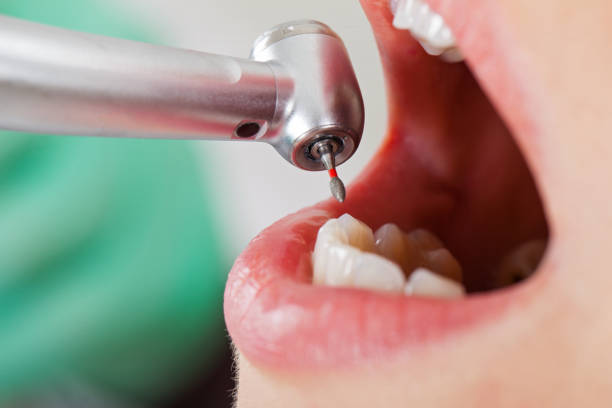 Best Root Canal Emergency Dentist  in Limon, CO
